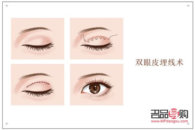 雙眼皮哪一種手術(shù)更好看(雙眼皮哪一種手術(shù)更好看些)