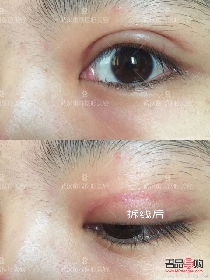 美容線拆線痛嗎(美容線拆線痛嗎多少錢)