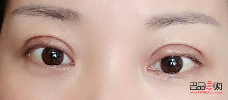 割雙眼皮二十天后的圖片(割完雙眼皮二十天的圖片)