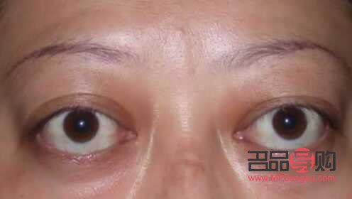 甲亢眼睛和正常人眼睛(眼球突出與正常眼圖片)