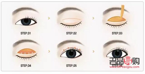 <h3>雙眼皮割深了怎么辦？專業(yè)修復與后期護理全解析</h3>