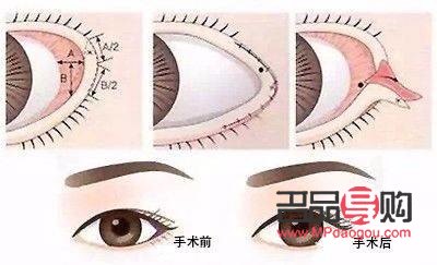 開眼角手術(shù)：塑造明亮大眼的新選擇