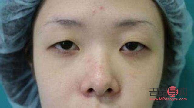 右眼眼皮耷拉下來了究竟怎么回事(右眼眼皮耷拉下來了究竟怎么回事兒)