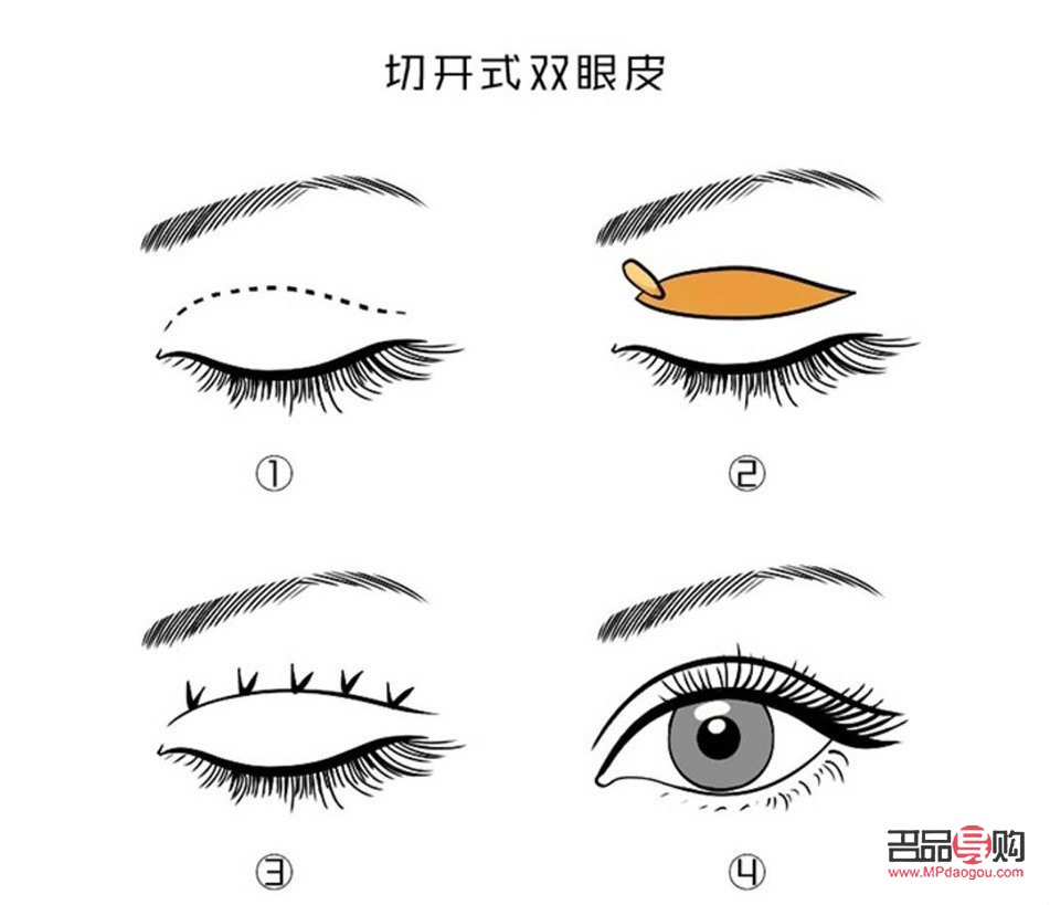 全切雙眼皮的弊端深度解析