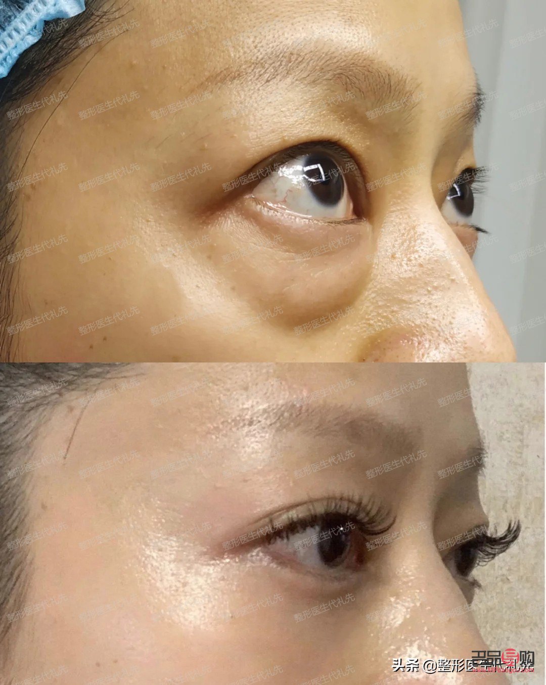 眼袋和淚溝一起做手術(shù)可以嗎(眼袋和淚溝一起做手術(shù)可以嗎多少錢)