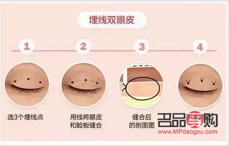 雙眼皮有三條線 是什么原因(雙眼皮有三條線 是什么原因造成的)
