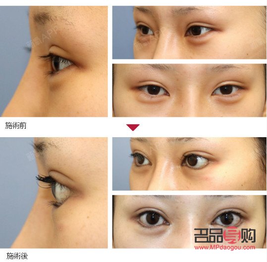 <h1>眼部綜合術(shù)：重塑明亮雙眸的全方位解決方案</h1>