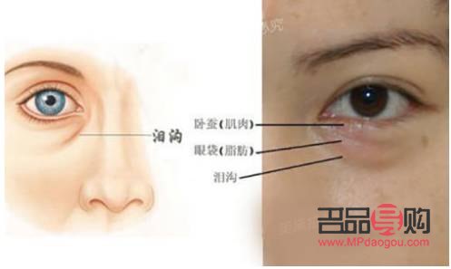 <h3>眶隔釋放眼袋整形術(shù)的風(fēng)險性探討</h3>