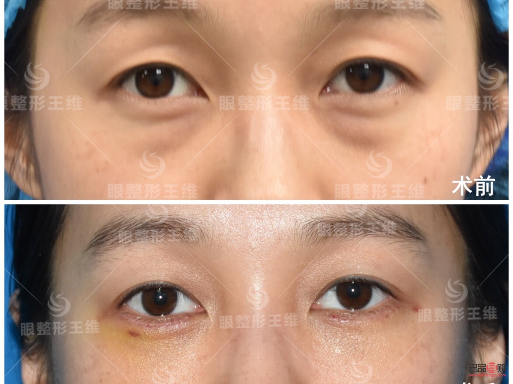 <h3>眶隔釋放眼袋整形術(shù)的風(fēng)險性探討</h3>