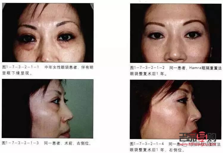 眶隔釋放眼袋整形術(shù)的風(fēng)險性探討
