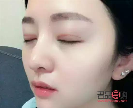 成功的雙眼皮閉眼痕跡(雙眼皮閉眼痕跡太重了)