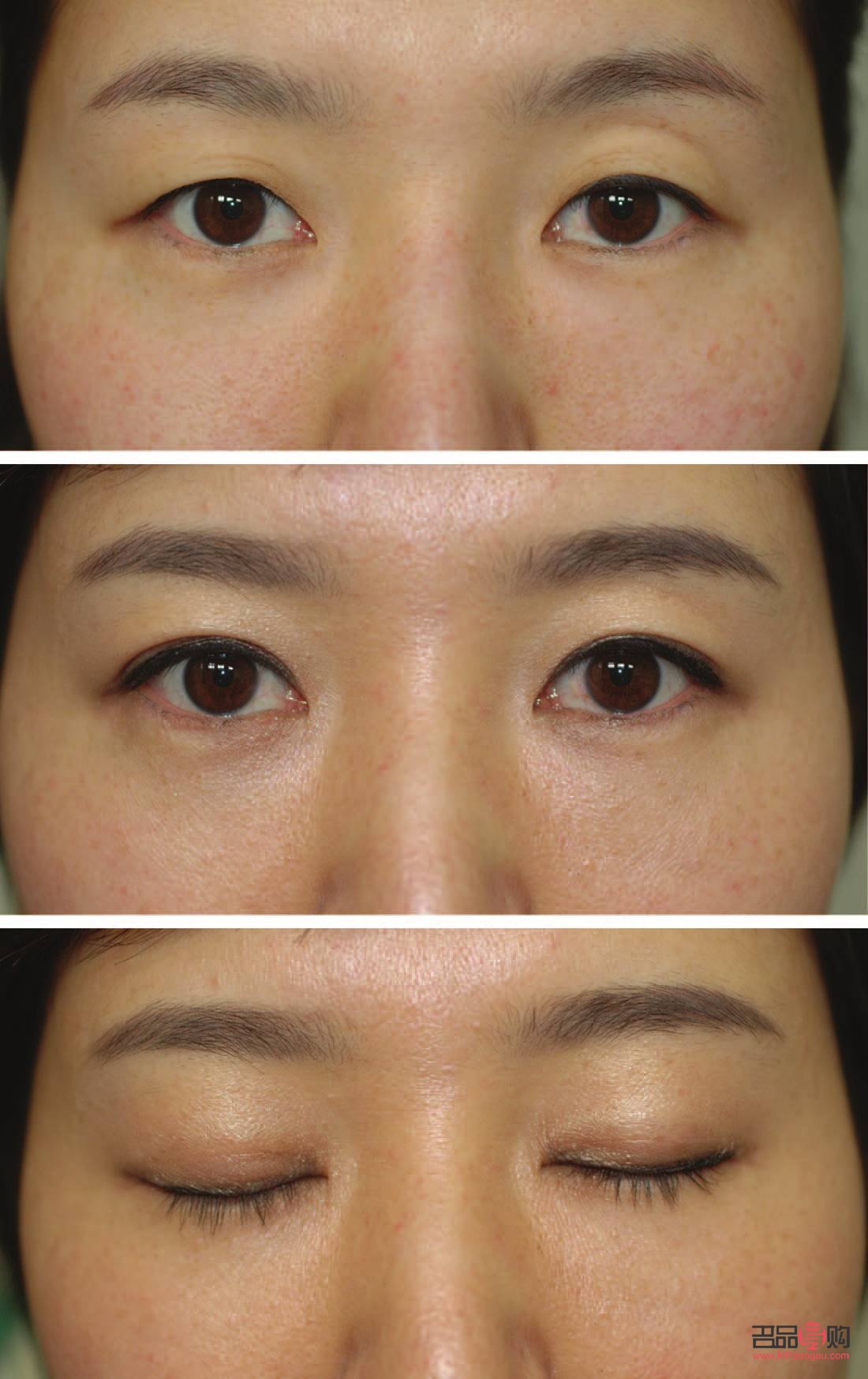 雙眼皮術(shù)后疤痕圖片(雙眼皮術(shù)后疤痕圖片大全)