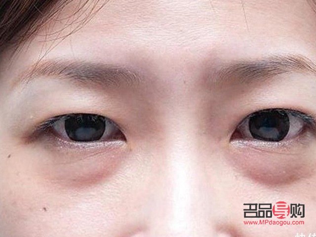 去眼袋的注意事項(xiàng)有哪些(去眼袋的注意事項(xiàng)有哪些呢)