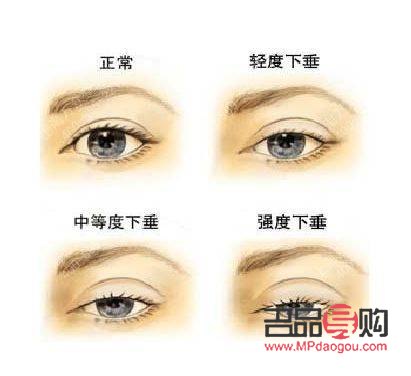 先天性眼皮下垂能治好嗎圖片(先天性眼皮下垂能治好嗎圖片視頻)