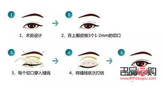 <h3>雙眼皮埋線：打造迷人電眼的秘密武器</h3>