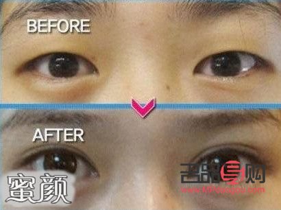 <h3>雙眼皮埋線：打造迷人電眼的秘密武器</h3>