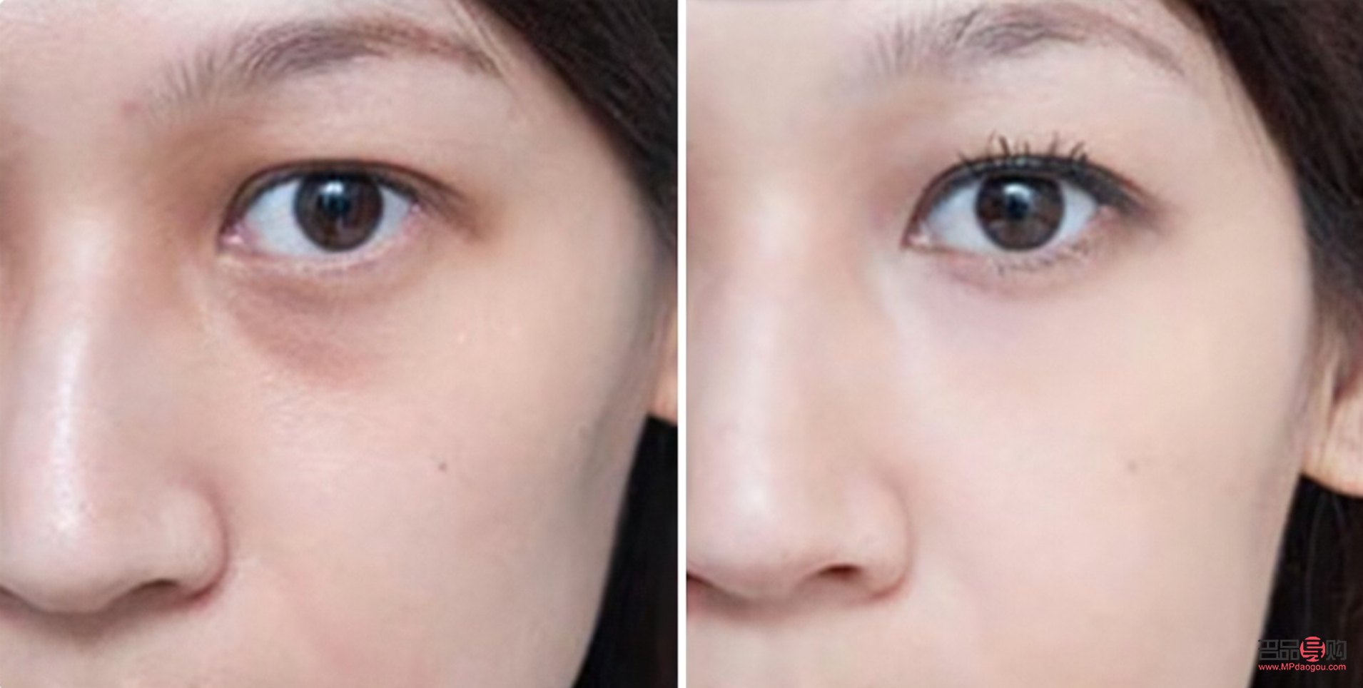 <h3>眼睛凹下去了怎么補救</h3>