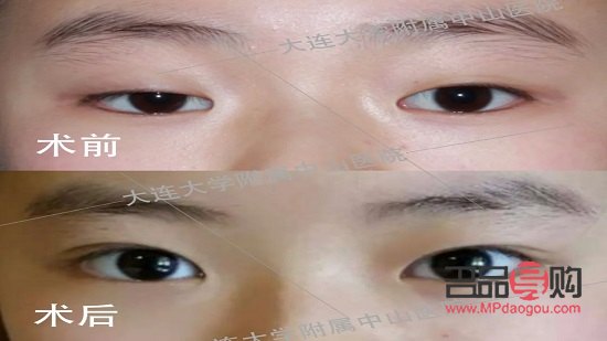 <h1>青少年眼瞼下垂：原因、影響與解決方案</h1>