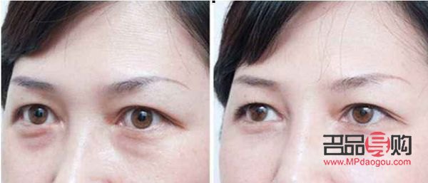 什么去眼袋效果最好(什么去眼袋效果最好護膚品)