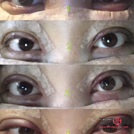 割雙眼皮手術(shù)對眼睛的可能傷害