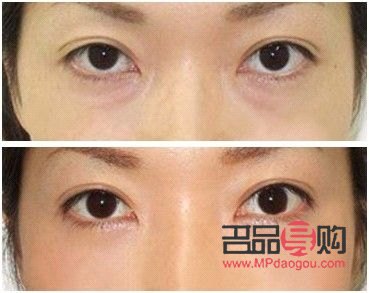 怎么樣消除黑眼圈黑眼袋(怎么樣消除黑眼圈黑眼袋最有效)