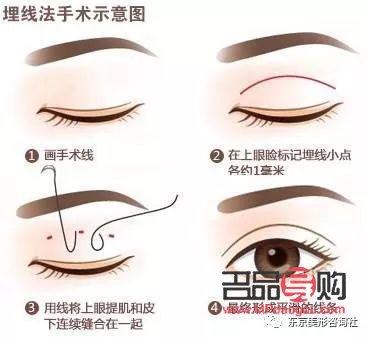 埋線雙眼皮和割雙眼皮哪種好(雙眼皮技術(shù)不開刀不埋線)