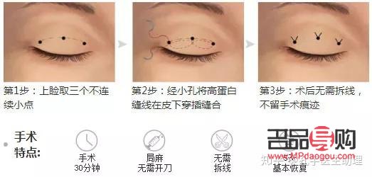 埋線雙眼皮和割雙眼皮哪種好(雙眼皮技術(shù)不開刀不埋線)