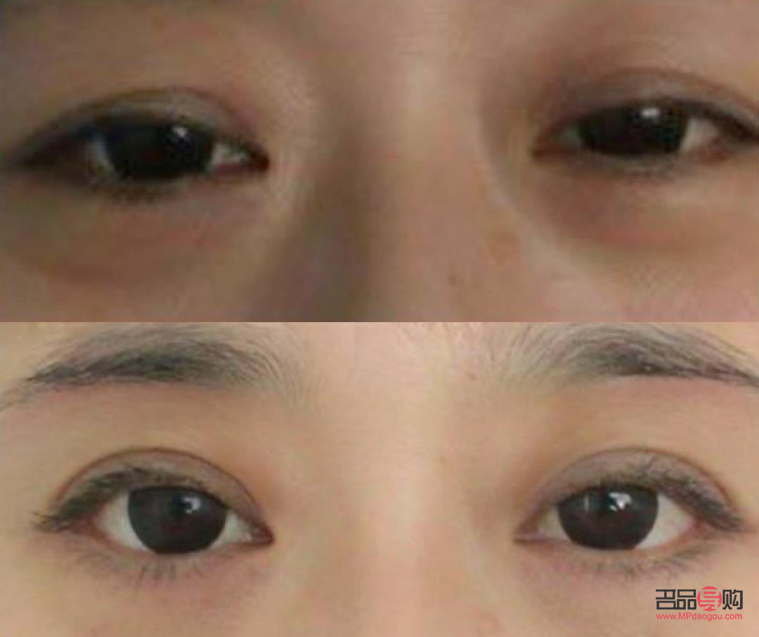 <h3>經(jīng)常貼雙眼皮貼，眼皮真的會(huì)松弛嗎？</h3>