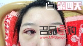 <h3>月經(jīng)期做雙眼皮手術(shù)，風(fēng)險與后果需知</h3>