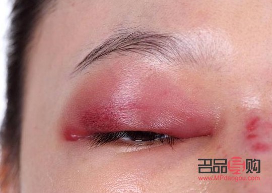 結(jié)膜炎上眼皮腫怎么辦(結(jié)膜炎上眼皮腫怎么辦圖面)