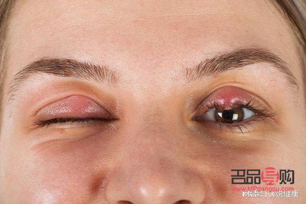 結(jié)膜炎上眼皮腫怎么辦(結(jié)膜炎上眼皮腫怎么辦圖面)
