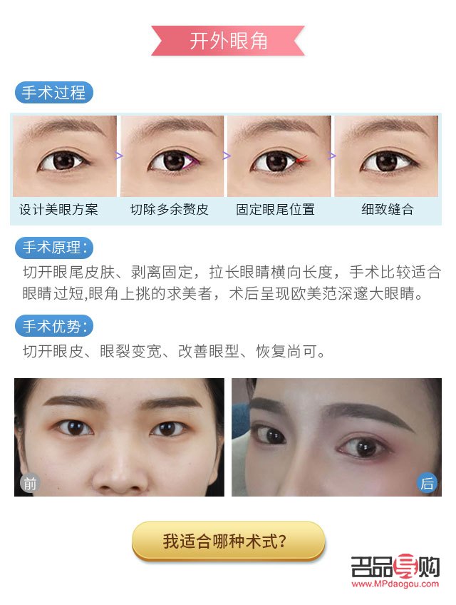 開(kāi)眼角要多少錢(qián)大概(開(kāi)眼角多少錢(qián)?)