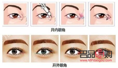 開眼角要多少錢大概(開眼角多少錢?)