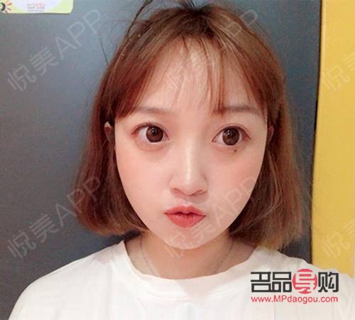 雙眼皮老了下垂怎么辦(雙眼皮老了下垂怎么辦呢)