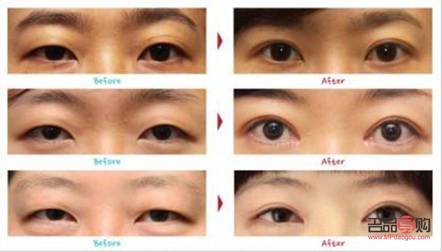 雙眼皮老了下垂怎么辦(雙眼皮老了下垂怎么辦呢)