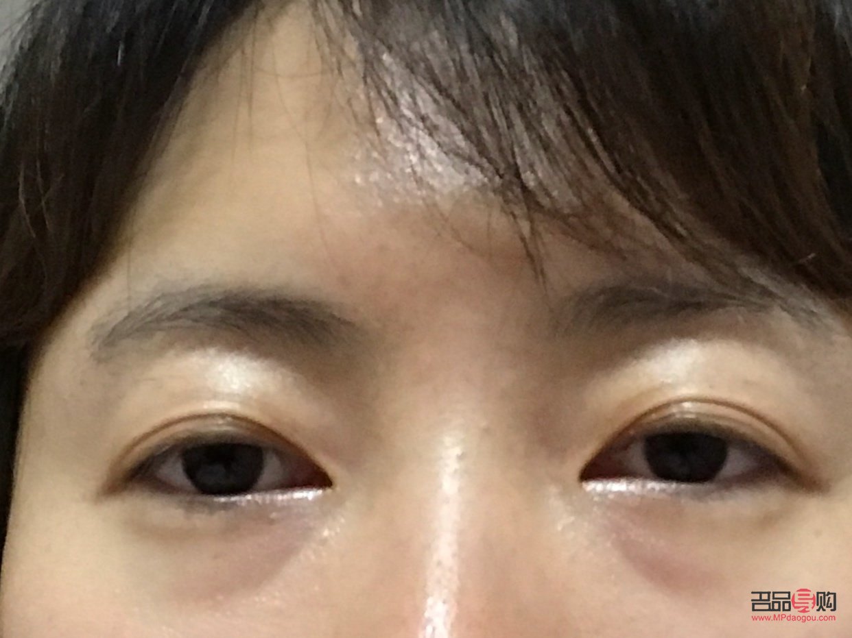 眼袋凹陷怎么恢復飽滿(眼袋凹陷怎么恢復飽滿不手術)