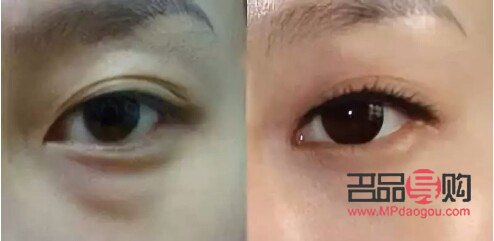 眼袋凹陷怎么恢復飽滿(眼袋凹陷怎么恢復飽滿不手術)