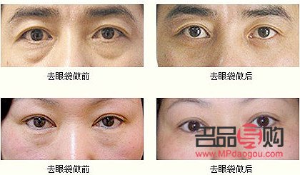 無痕眼袋手術及其費用詳解