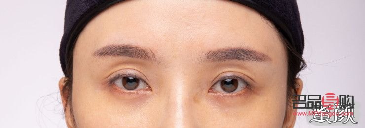 黑眼圈眼眶凹陷怎么恢復飽滿呢(黑眼圈眼眶凹陷怎么恢復飽滿呢圖片)