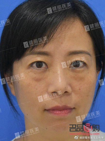 <h3>四十多歲，做眼袋手術(shù)是否合適？</h3>