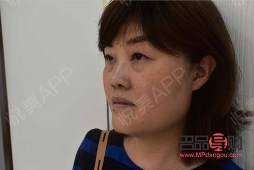 <h3>四十多歲，做眼袋手術(shù)是否合適？</h3>