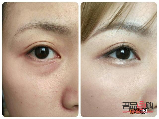 <h3>四十多歲，做眼袋手術(shù)是否合適？</h3>