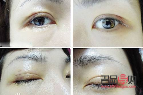 雙眼皮割深了的處理方法與注意事項(xiàng)