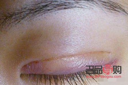 雙眼皮手術(shù)疤痕多久能恢復(fù)自然(雙眼皮手術(shù)疤痕多久消失)