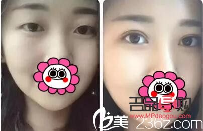 雙眼皮修復成功案例(雙眼皮修復成功案例圖片)