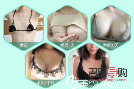 雙眼皮修復成功案例(雙眼皮修復成功案例圖片)