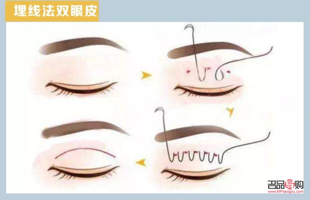 修復埋線雙眼皮寬度不一的方法與注意事項