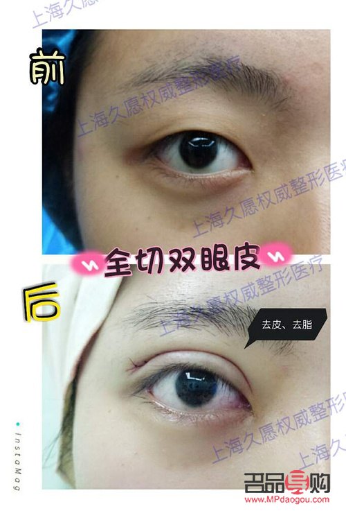 割雙眼皮對以后會有什么影響嘛(割雙眼皮對以后會有什么影響嘛圖片)