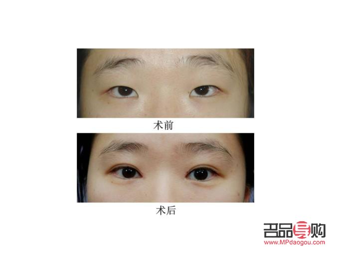 割那種雙眼皮恢復的快(割那種雙眼皮恢復的快嗎)