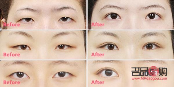 先天性腫眼泡怎么消除圖片(先天性腫眼泡怎么消除圖片大全)